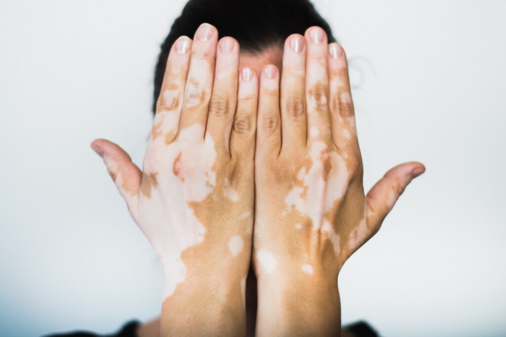 fototerapia para vitiligo